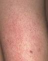 Keratosis Pilaris results when