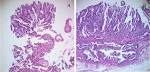 Gastric Carcinoma: Morphologic Classifications and Molecular