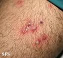 Infectious <b>folliculitis</b> which