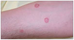 Image result for tinea corporis