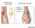 Terapia de <b>radiación</b>: