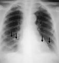 PULMONARY EMBOLISM