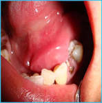 <b>Sublingual Gland Neoplasms</b>
