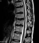 File:Transverse <b>myelitis</b> MRI.