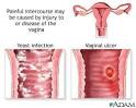 Causes of painful intercourse - Sexual intercourse - painful ...