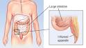 <b>Appendicitis</b> Guide: Causes, Symptoms and Treatment Options