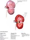 <b>Chronic kidney disease</b> is