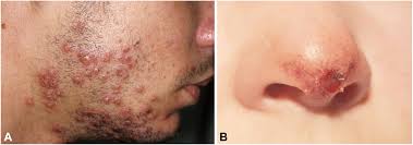 Attēlu rezultāti vaicājumam “Diderma simplex sessile”