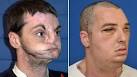 face transplant to date.