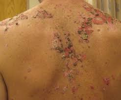 Attēlu rezultāti vaicājumam “Pemphigus borealis”