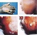 CDC Anthrax | Images: Cutaneous Anthrax