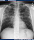 Bacterial Pneumonia | Humen Healths