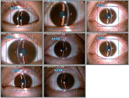 Kuvahaun tulos haulle Kayser-Fleischer