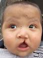 230px-Cleftlipandpalate.JPG