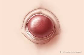 Attēlu rezultāti vaicājumam “Diderma umbilicatum young”