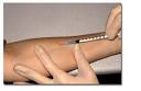 <b>tuberculin</b> skin test being