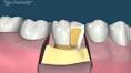 Periodontia <b>Aumento</b> de <b>Coroa</b>