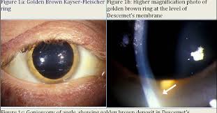 Kuvahaun tulos haulle Kayser-Fleischer