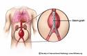 Abdominal Aortic Aneurysm