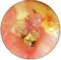 <b>Otitis Externa</b>