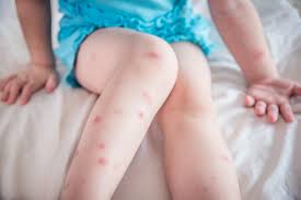 Image result for bed bug bites