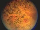<b>Retinitis Pigmentosa</b>: #2