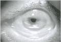 Occhio affetto da <b>tracoma</b>,