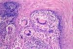 <b>granulomatous foreign body</b>