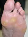 El RinCon dEl P0doLoG0**: Callos en los pies