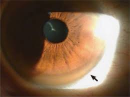 Kuvahaun tulos haulle Kayser-Fleischer