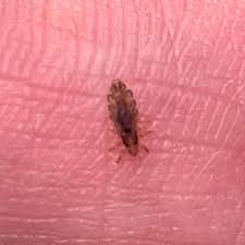 Attēlu rezultāti vaicājumam “Pediculus humanus capitis”