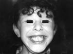 Williams syndrome patients