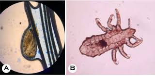 Attēlu rezultāti vaicājumam “Pediculus humanus capitis”