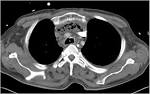 <b>mediastinitis</b>: two case