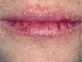 How To Cure Chapped Lips