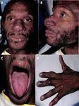 tongue lesion and (D) left