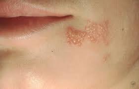 Attēlu rezultāti vaicājumam “Diderma simplex”