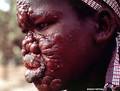 Leprosy has now turned