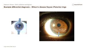 Kuvahaun tulos haulle Kayser-Fleischer