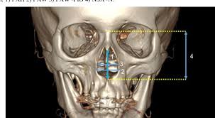 Attēlu rezultāti vaicājumam “Cribraria piriformis”