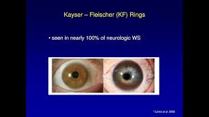 Kuvahaun tulos haulle Kayser-Fleischer