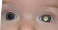 <b>Retinoblastoma</b> Treatment and