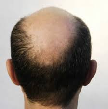 Hair Loss Prevention