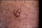 a cutaneous <b>neurofibroma</b>