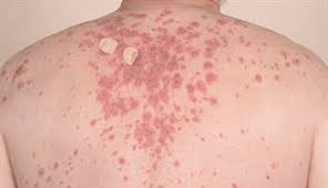 Attēlu rezultāti vaicājumam “Pemphigus borealis”