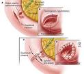 <b>Sphincter</b> of <b>Oddi Dysfunction</b>