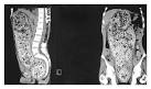 Severe Fecal Impaction — NEJM
