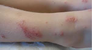 Image result for bed bug bites