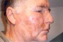 Employee suffers acid burns to his face Safety News