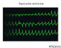 <b>Taquicardia</b> ventricular